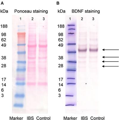 The Role of Brain-Derived Neurotrophic Factor in Irritable Bowel Syndrome